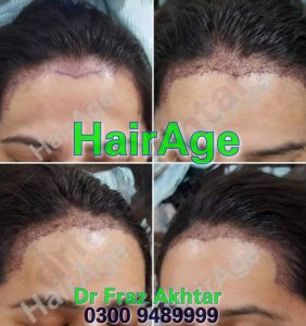 Female Before and After