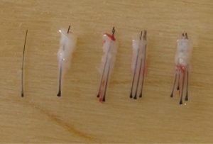 Hair Transplant Procedure