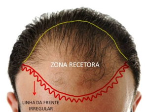 Hair Transplant Procedure