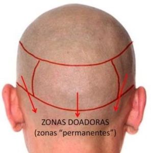 Hair Transplant Procedure