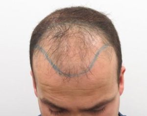 Hair Transplant Procedure