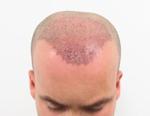 Hair Transplant Procedure