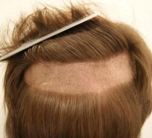 Hair Transplant Procedure