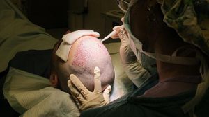 Hair Transplant Procedure